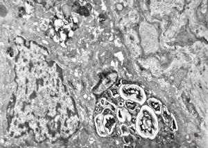 F,17y. | congenital liver fibrosis … myelinoid inclusions F,17y. | congenital liver fibrosis … myelinoid inclusions
